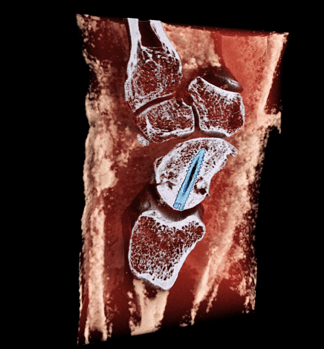 MARS Bioimaging partners with the Hospital for Special Surgery (HSS)